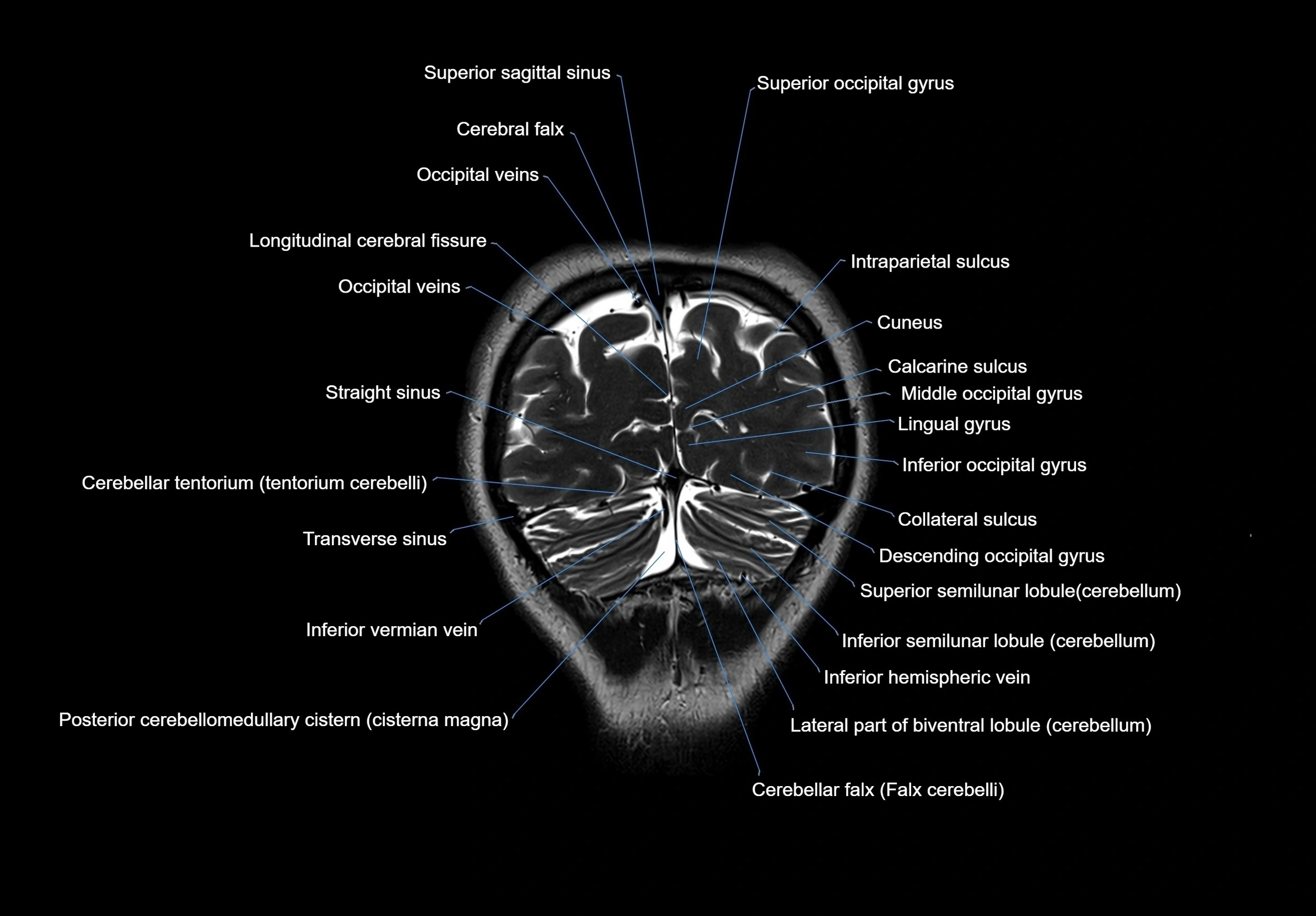 MRI Brain coronal cross sectional labelled anatomy 3T image  -img-00001-00064.webp